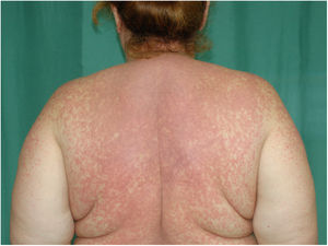 Confluent erythematous violaceous papules and plaques on the back.