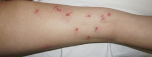 Multiple lesions exhibiting the comet sign on the leg of Patient 1.