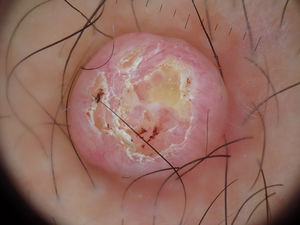 Dermoscopic image of the lesion.
