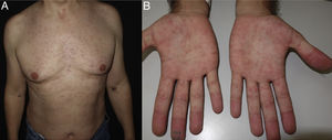 Acute antiretroviral syndrome with morbilliform erythematous macular rash on the trunk (A) and palms (B).