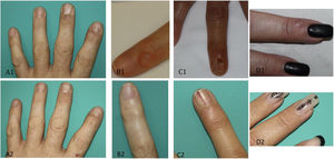 Pretreatment (1) and posttreatment (2) photographs of myxoid cysts in third left DIJ (A1,A2), fifth left DIJ (B1, B2), fourth right DIJ (C1, C2), and third left DIJ (D1,D2). DIJ indicates distal interphalangeal joint.