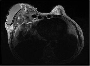 Magnetic resonance image of a retroprosthetic lobulated mass measuring 14 × 10 × 7 cm with irregular margins in addition to peripheral enhancement and central necrosis and invasion of the chest wall through to the mediastinum.
