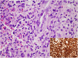 A, Microscopic image of the cell block preparation from the periprosthetic fluid (hematoxylin-eosin, original magnification ×60) showing large loose and small discohesive clusters of pleomorphic tumor cells against a background of inflammatory granulation tissue. B, Strong immunohistochemical expression of CD30.