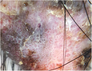 Dermoscopic appearance of the lesion (polarized light dermoscopy).