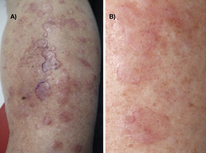 A, Raised, flat erythematous-pink pretibial plaques. B, Higher-magnification view. Note the dotted red lesions inside and outside the lesions with a fine collarette.