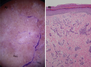 A, Dermoscopic image showing dots and homogeneous red blood vessels, scaling, white structureless areas, and a peripheral ink-stained collarette. B, Proliferation of dilated capillaries in the papillary dermis without atypia and edema (hematoxylin-eosin, original magnification ×10).