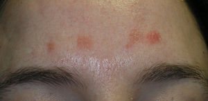 Orange, scaling papules on the forehead.