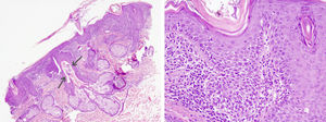Mild epidermal acanthosis, hyperkeratosis with foci of parakeratosis, follicular corneal plugging, a moderate inflammatory infiltrate in the superficial dermis, and Demodex species in the central follicle (arrows) (left, original magnification ×40; right, original magnification ×200).