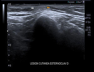 Ultrasound study with well-defined nonencapsulated, hypoechoic subcutaneous lesion.
