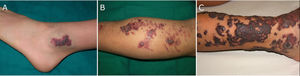 Clinical images of verrucous venous malformations. A, Patient 1. Verrucous erythematous violaceous plaque on the left ankle. B, Patient 2. Erythematous, violaceous, hyperkeratotic plaques with satellite lesions and hemorrhagic superficial vesicles on the back of the right leg. C, Patient 3. Erythematous, violaceous plaques with a verrucous surface comprising hyperkeratotic areas and crusts involving the circumference of the distal region of the left leg.