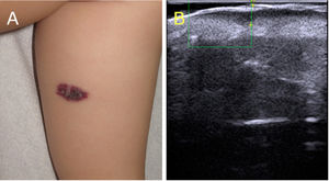 Clinical and ultrasound image of an angiokeratoma. A, Angiokeratoma circumscriptum. Erythematous plaque with a hyperkeratotic surface, clinically indistinguishable from verrucous venous malformation. B, Cutaneous ultrasound (22 MHz). Epidermal hyperechogenicity with vascular channels limited to the papillary dermis; no color Doppler signal.