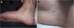 Clinical images. A, Two lesions (←) on the instep and sole of the right foot. B, Erythematous dome-shaped umbilicated papule (←) on the sole of the right foot.