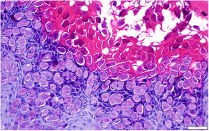 Histopathology image. Intracytoplasmic inclusion bodies (Henderson-Paterson bodies of Molluscum), represented as circular hyaline and eosinophil spheres, inside the keratinocytes (hematoxylin–eosin, × 200).