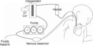 Diagram of the elements making up a conventional ECMO circuit.