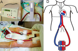 Support treatment with pumpless AV iLA in a patient with bronchiopleural fistula and severe respiratory failure. Orotracheal intubation, mechanical ventilation with PEEP at 10 cm H2O and tidal volume of 1 ml/kg ideal body weight. A) Exchange membrane and arterial and venous cannulations. B) Close up of the iLA connected to arterial and venous lines and the oxygen intake. C) Flow measure across the system, in this case 1.77 litres of blood per minute. D) AV cannulation diagram for treatment with an interventional lung assist system (iLA).