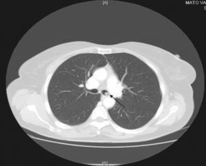 Nodular lesion in the left main bronchus, which corresponds to the carcinoid tumour.