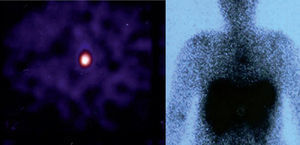 Rounded focus with high uptake, located at the mediastinum, compatible with the somatostatin receptor carrier process.