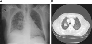 A. Chest X-ray: right para-tracheal node. B. Chest CT: close-up of right para-tracheal node.