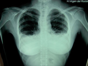 A simple chest X-ray shows bilateral pleural effusion after surgery.