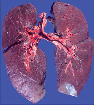 The lungs in the section had a diffuse haemorrhagic appearance and lack of normal “sponginess”, with extensive solidification.