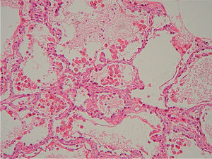 Histological detail of the lung stained with haematoxylin and eosin which shows numerous macrophages with clear brownish-grey granules in their interior. The alveolar walls showed no signs of thickening. No vasculitis was observed.