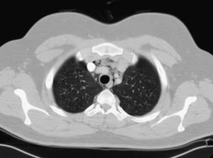 Chest CT: presence of air in the mediastinal compartment.