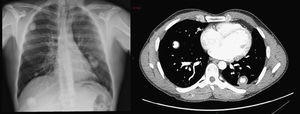 Radiograph and CT with bilateral pulmonary nodules.