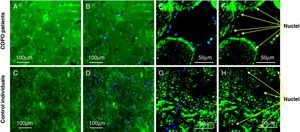 Microscope images of quadriceps muscle slices from COPD patients and control subjects, demonstrating in the myotubules the localisation of YY1 with immunohistochemistry with regard to the muscle nuclei. (A–D) Wide-field microscope images. E-H: images from a confocal microscope with cross-sectional quadriceps muscle cuts that demonstrate the YY1 stain in green and for the nuclei with 4′,6-diamidino-2-phenylindole in blue (B, D, E, and G) and the same cuts that show staining for YY1 only in green (A, C, F, and H). (A, B, E, and F) The slices of a patient in whom the anomalous staining pattern of the factor was identified in the nucleus as well as in the cytoplasm. (C, D, G, and H) From a control subject showing exclusively cytoplasmic YY1 staining.