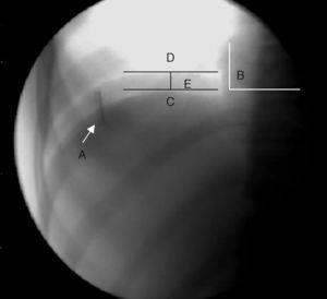 Measurement of the excursion of the diaphragmatic cupula during calm breathing. (A) arrow: metallic object; (B) white L-shaped lines: vertebra position; (C) lower horizontal line: cupula of the diaphragm during inspiration; (D) upper horizontal line: cupula of the diaphragm during expiration; (E) small vertical line between the two horizontal lines: excursion of the diaphragm cupulas during calm breathing (see the text for more information).