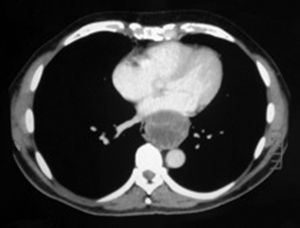 CT axial cut showing a posterior mediastinal mass compressing the esophageal lumen and the left auricle.