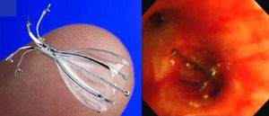 Appearance of an unfolded IBV valve and endoscopic view after its placement.