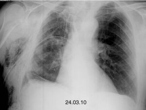 Reexpansion of the right pneumothorax.