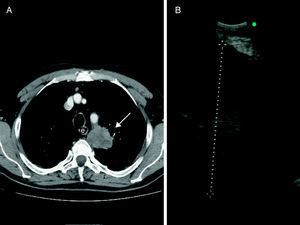 (A) Computed tomography showing a mass (arrow) in the left upper lobe, next to the esophagus (e). (B) Ultrasound image of the mass through the esophagus.