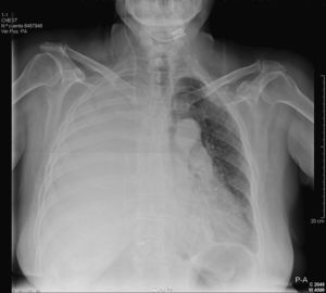 Massive right pleural effusion secondary to ventriculo-pleural shunting.