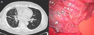 (A) Perihilar interstitial affectation and mediastinal adenomegalies; (B) thoracoscopic image showing the dilatation of the subpleural lymphatic vessels, lymphorrhea and the resulting chylothorax.