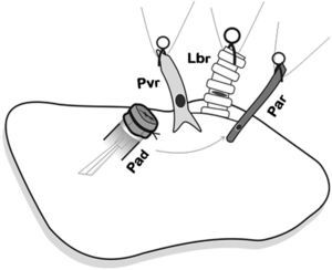 Placement of the donor lung on the recipient lung and introduction of the cuffs on each of the corresponding structures and later anastomosis. First, the arterial anastomosis was done. Pad: pulmonary artery of the donor; Par: pulmonary artery of the receptor; Lbr: left bronchus of the recipient; Pvr: pulmonary vein of the receptor.