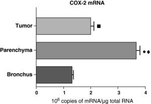 COX-2 mRNA expression in the tumor, lung parenchyma and bronchi of the COPD patients with squamous carcinoma (n=27). The means are represented with the standard deviations from the mean. The expression of mRNA is shown as the number of molecules compared with total RNA. • P<.001 between parenchyma and tumor; ♦ P<.0001 between parenchyma and bronchus; ¿ P<.01 between tumor and bronchus.