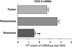 COX-2 mRNA expression in the tumor, lung parenchyma and bronchi of COPD patients with adenocarcinoma (n=17). The means are represented with the standard deviations from the mean. The expression of mRNA is shown as the number of molecules compared with total RNA. • P<.03 between bronchus and tumor; ¿ P<.03 between bronchus and parenchyma. There were no statistically significant differences between parenchyma and tumor.