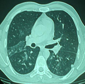 Chest computed tomography shows a micronodular pattern with patchy ground glass areas.