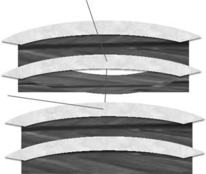 Modified intracostal suture technique: the stitches pass through the cephalic and caudal ribs and along the space left by the flap, over the intercostal muscle and the neurovascular bundle; this impedes its compression.