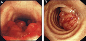 Bronchoscopic image of endoluminal tracheal tumors requiring the insertion of self-expanding metallic stent (SEMS).
