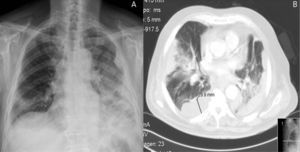 Posteroanterior chest X-ray (A) and computed tomography (B) show extensive alveolar infiltrates predominantly in the left hemithorax and several organized pleural collections in a patient with empyema due to Legionella pneumophila.