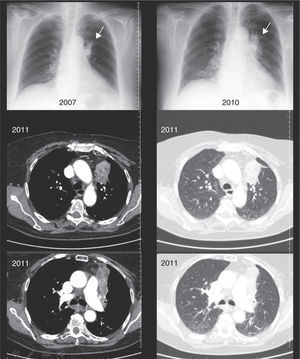 Chest radiography and CT of case 2 showing a mass/atelectasis in the left upper lobe.