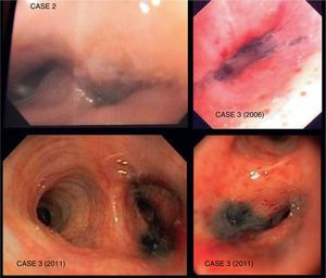 Endoscopic images of cases 2 and 3 showing maculae and anthracotic-looking blackish-purple mass and stenosis of the opening of the left lower lobe (case 2) and the anterior and apical-posterior openings of the left upper lobe (case 3).
