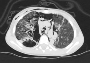 Thoracic CT revealing interstitial emphysema in both lungs (with areas of focal emphysema in the right middle lung field) and diffuse pneumomediastinum with related subcutaneous emphysema.