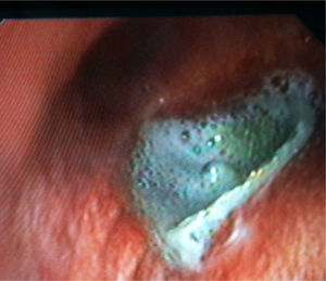 Endoscopic image once the device was anchored in the right main bronchus.