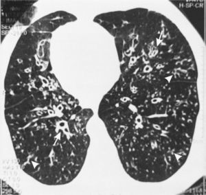 The high-resolution computed tomography (HRCT) of patient number 8 demonstrating dextrocardia, diffuse centrolobulillar nodules with “tree-in-bud” pattern (arrowheads) in the pulmonary periphery with bronquiolectasis/bronquiectasis and diffuse thickening of the bronchial wall (arrow).