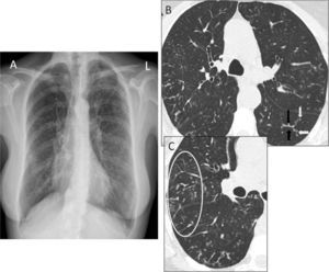(A) Posteroanterior chest radiograph where diffuse bilateral micronodular interstitial pattern can be observed. (B) Thoracic HRCT image showing “tree-in-bud” pattern, consisting of branching structures (black arrows) and buds (white arrows). (C) A wider view with abundant peripheral buds (circle, C).