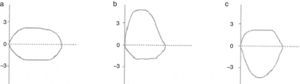 Morphology of the flow–volume curve in the obstruction of the upper airway: (a) permanent obstruction; (b) variable extrathoracic obstruction: the obstruction increases during inspiration; (c) variable intrathoracic obstruction: the obstruction increases during expiration.