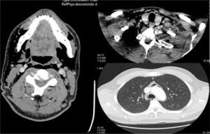 Cross-sectional CT images of the mandibular, inferior cervical and superior mediastinal areas. There is observed widespread emphysema that dissects the bilateral cervical muscle planes and affects the parapharyngeal and prevertebral spaces, floor of the mouth, submandibular space and posterior cervical space, reaching the mediastinum and causing pneumomediastinum. These findings are asymmetrical and more evident on the right side.